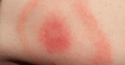 La malattia di Lyme: batterio che ha colpito la Cabello