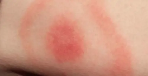 La malattia di Lyme: batterio che ha colpito la Cabello