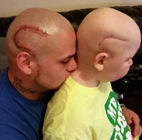 Usa, il piccolo Gabriel non ce l'ha fatta: il papà si tatuò la cicatrice come la sua
