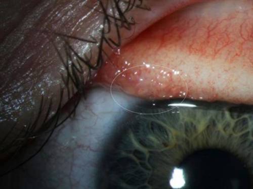 "Ho un fastidio all'occhio": e scopre di avere dentro 14 vermi