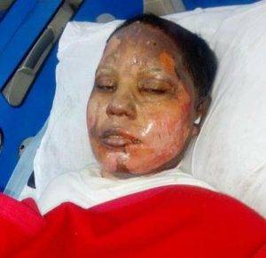 È morta Asma, giovane cristiana arsa viva in Pakistan