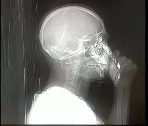 Risponde al cellulare durante la Tac, medici allibiti a Napoli