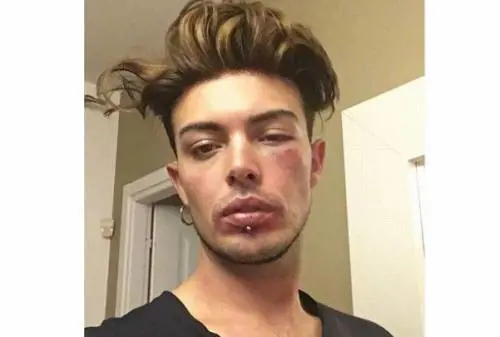 Stash e la foto col volto pestato: "Stavo difendendo una ragazza"