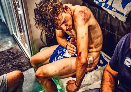 Tour de France, Jungels mostra le ferite dopo la caduta: foto choc su Twitter
