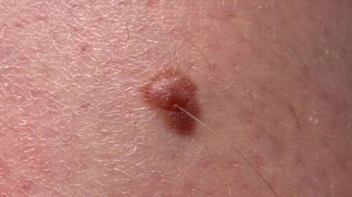 Un nuovo test del sangue per identificare il melanoma