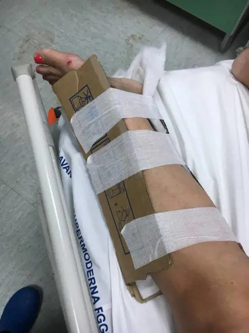 Reggio Calabria, manca il gesso: le fratture steccate col cartone