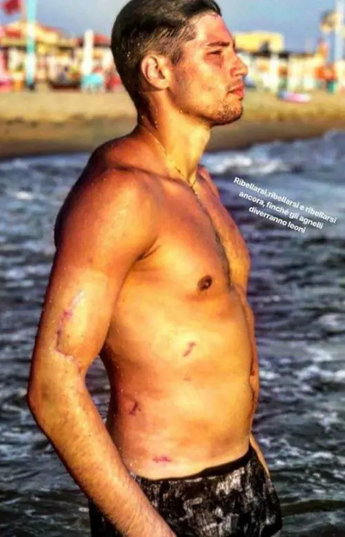 Per Niccolò Bettarini relax al mare E mostra i segni delle coltellate