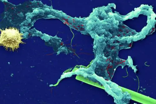 Muore a 10 anni infettata dall'ameba "mangia cervello"