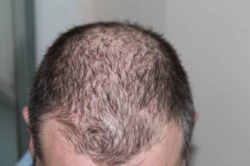Cura della calvizie: nell’80% dei pazienti i capelli ricrescono
