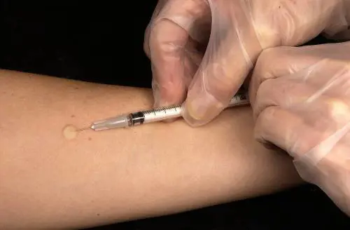 Studente scuola media colpito da tubercolosi: paura tra i compagni