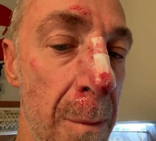 Brutta caduta per Linus: ​naso rotto e tre punti