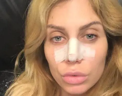 Paola Caruso operata d'urgenza al naso dopo una "borsettata"