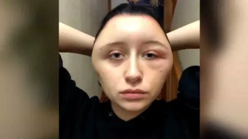 Ha una reazione allergica dopo tintura per capelli: la faccia si gonfia di 63 cm