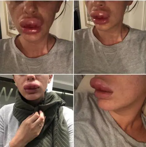 L'iniezione di botox tocca l'arteria: le labbra diventano enormi