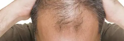 Medici finti trapiantavano capelli in ospedale, denunciati 