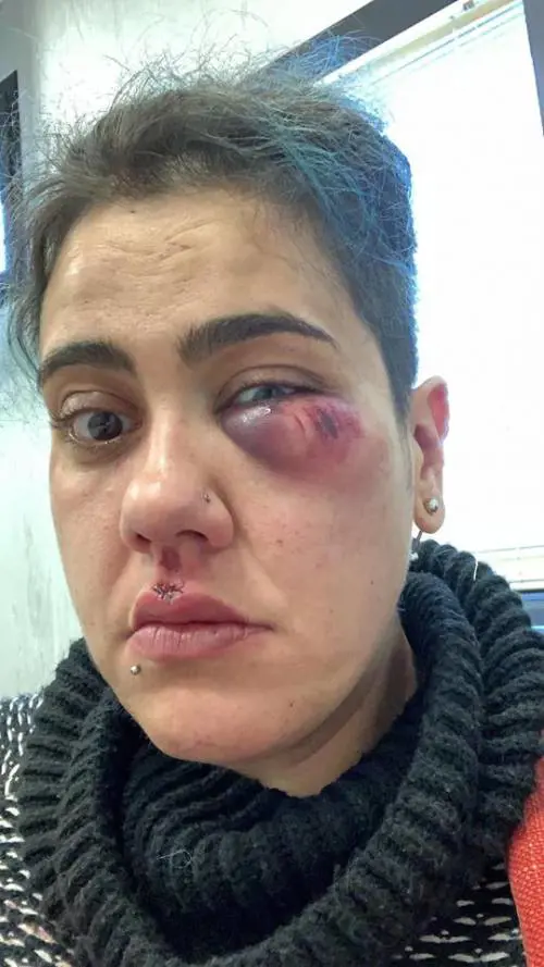 Aggressione choc a Bolsena: ragazze picchiate al grido di "muori lesbica"