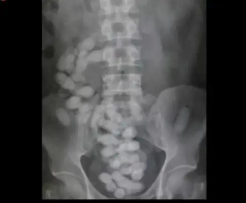 Olbia, fermato corriere della droga: in corpo eroina per 100mila euro