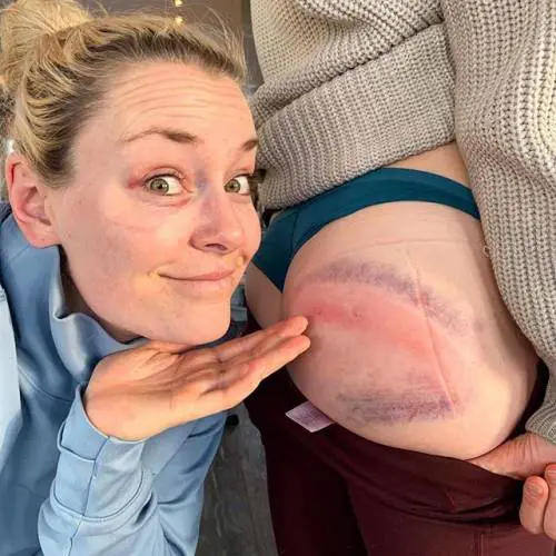 Sci, Lindsey Vonn e i lividi sul lato B: ''Di che colore sarà domani?''