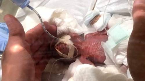 Il miracolo del più piccolo prematuro: da 268 grammi a oltre 3 chili in due mesi