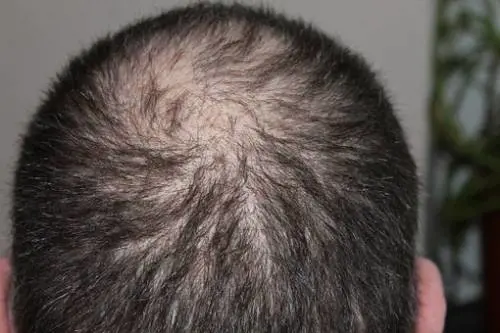 Si fa il trapianto di capelli e muore all'improvviso per una reazione allergica