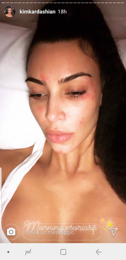 Kim Kardashian si mostra senza trucco e con la psoriasi