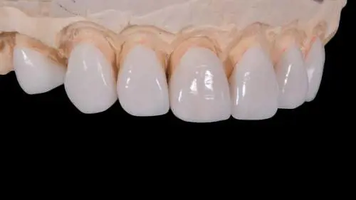 Dimentica la dentiera nel vassoio del pranzo e dice addio ai denti