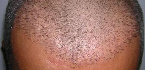 Assume farmaco contro calvizie e resta impotente: scatta la denuncia