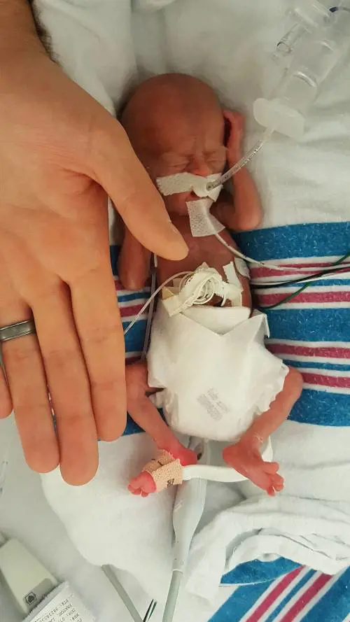 Pesa 300 grammi e sopravvive: il miracolo del piccolo prematuro