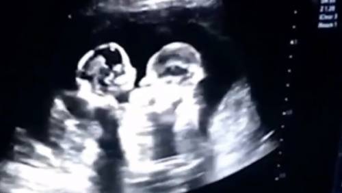 Le gemelline 'combattono' nel grembo materno e il video diventa virale