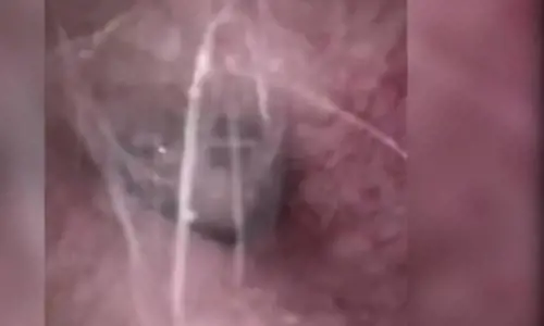 Ragno nell'orecchio di paziente, scoperta choc di un medico in Cina