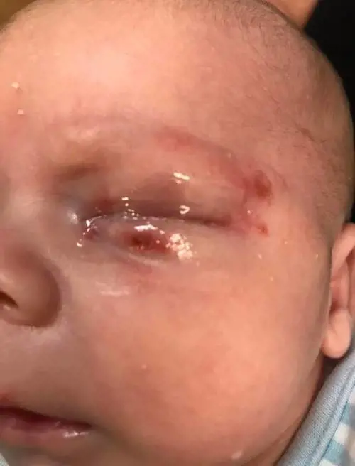 Baciato da un parente con l'Herpes: neonato rischia di morire