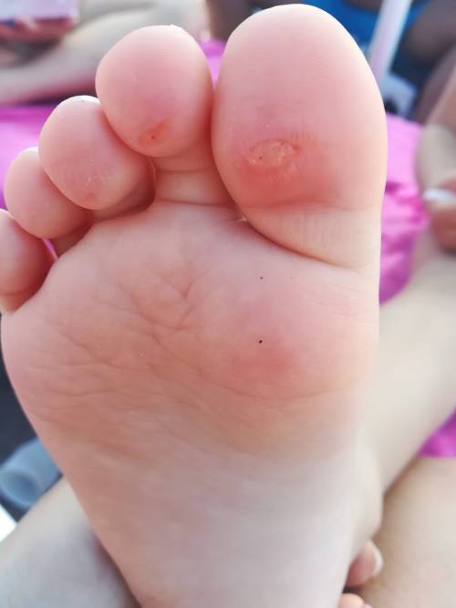 Pareo Park, 150 bambini colpiti da infezione: bolle e sangue sui piedi