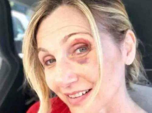 Incidente per Lorella Cuccarini: "Per colpa di una buca"