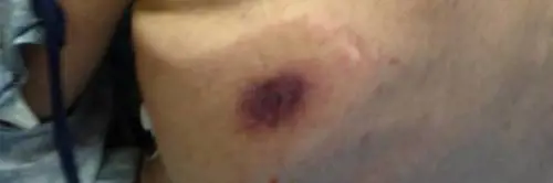 Batteri mangiacarne, uomo muore dopo 48 ore