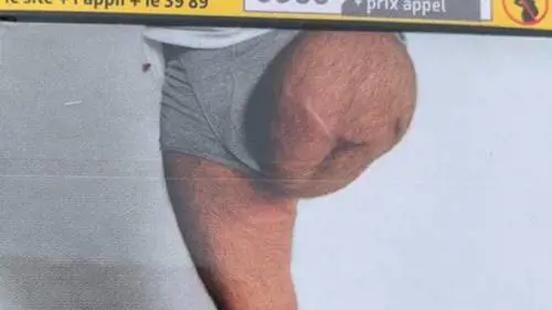 Trova la foto della sua gamba amputata sul pacchetto di sigarette