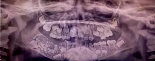L'estrazione da record: tolti 526 denti a un bambino di 7 anni