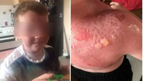 Bimbo gravemente ustionato da crema solare finisce in ospedale