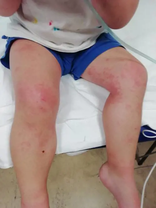 Bimbo in ospedale dopo aver mangiato budino