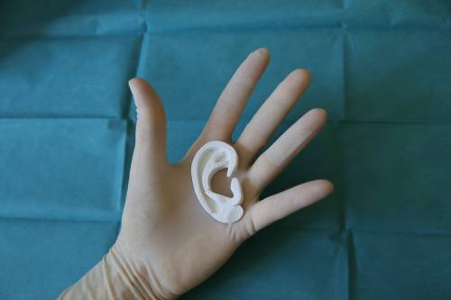 Ricostruito l'orecchio di un bambino con la stampa 3D
