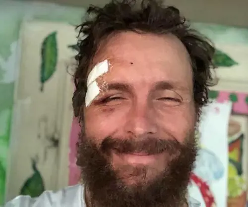 Incidente per Jovanotti che mostra i punti sul sopracciglio: "Non è niente”