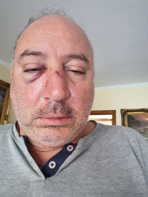 "Pugni e calci, erano in quattro". Aggredito il consigliere leghista