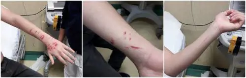 "Mi hanno ferito con una lametta": studente 14enne inventa aggressione