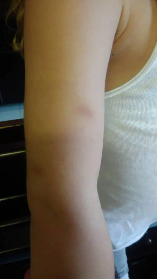Quei lividi sospetti sul corpo dei bimbi dell'asilo Isola dei Tesori