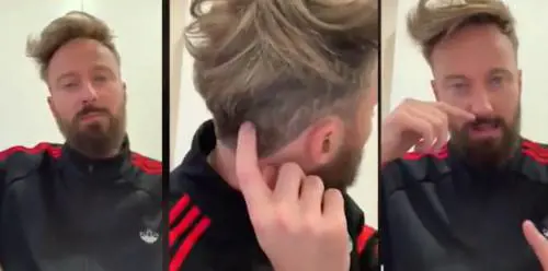 Francesco Facchinetti rivela il suo trapianto non chirurgico: "Ho i capelli da Re Leone!"