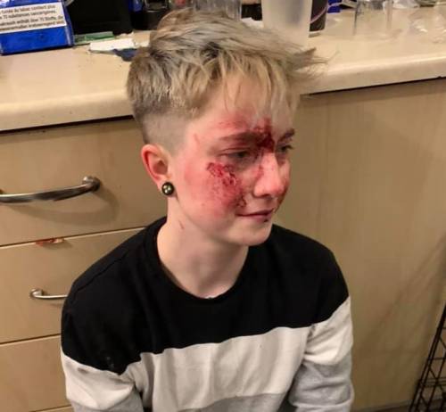 Aggredita in strada perché lesbica, 20enne mostra le foto sui social