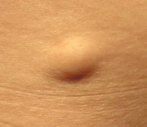 Lipoma, quali sono i sintomi e come si cura