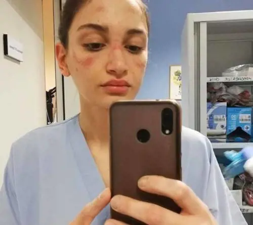 L'infermiera con il volto segnato dalla mascherina: "State in casa"