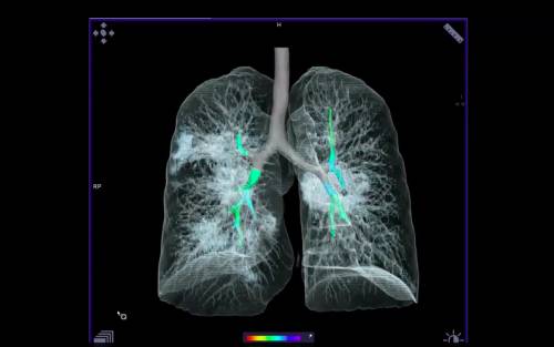 Gli esperti e le "foto" di Covid: "È simile a tumore ai polmoni"