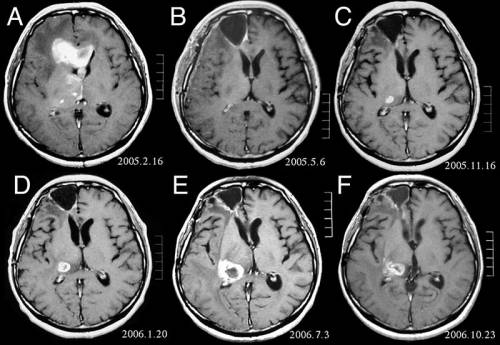 Astrocitoma, come si manifesta questo tumore cerebrale?