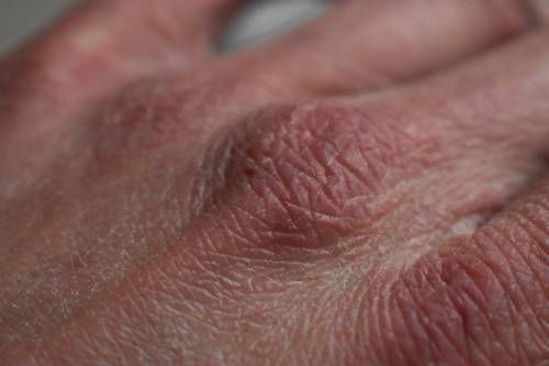 Gel igienizzanti e mani secche: ecco come non rovinare la pelle